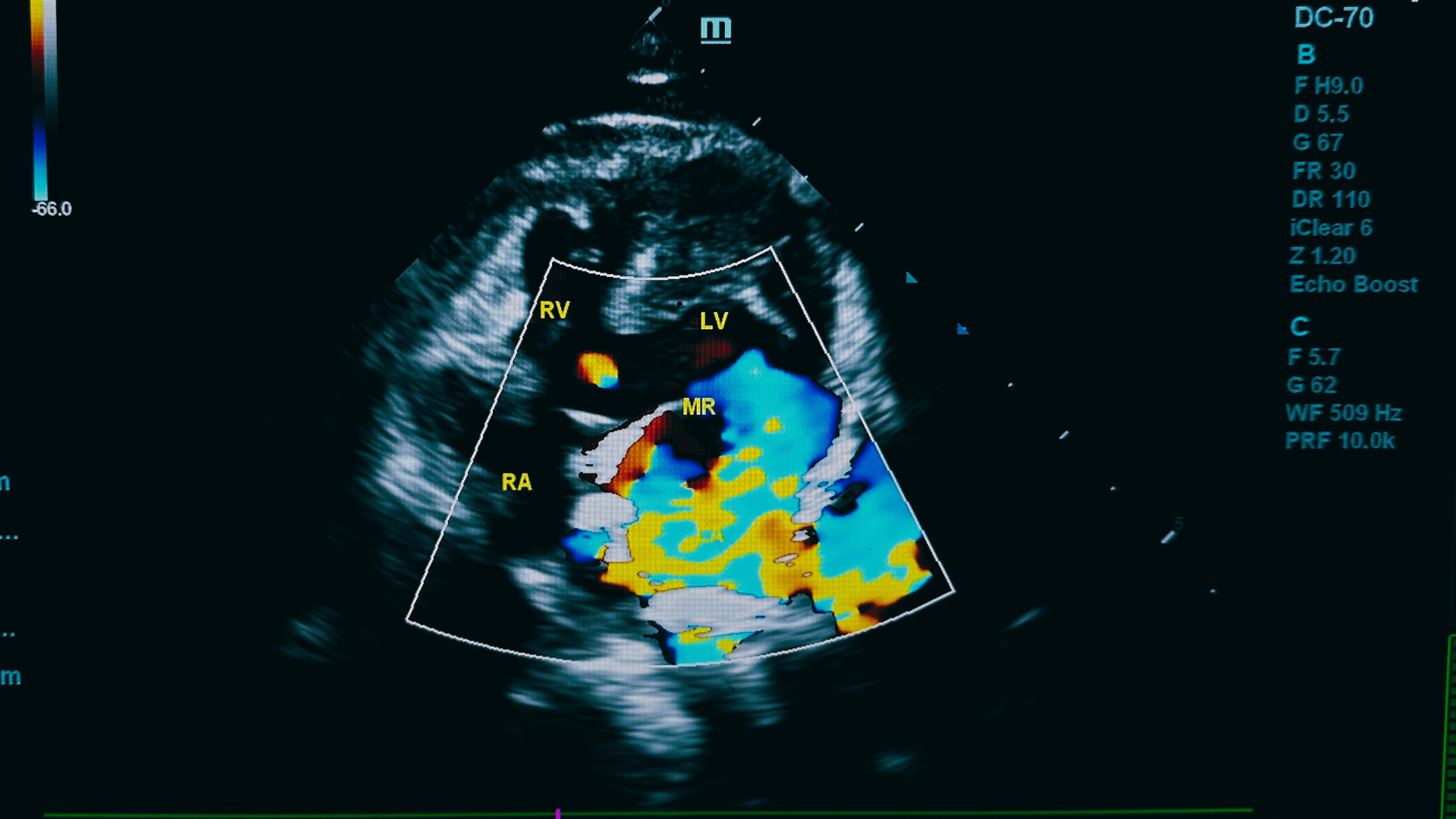 Echocardiogram image showing the heart with labeled chambers (RV, LV, RA) and colorful blood flow patterns, captured using DC-70 ultrasound device.